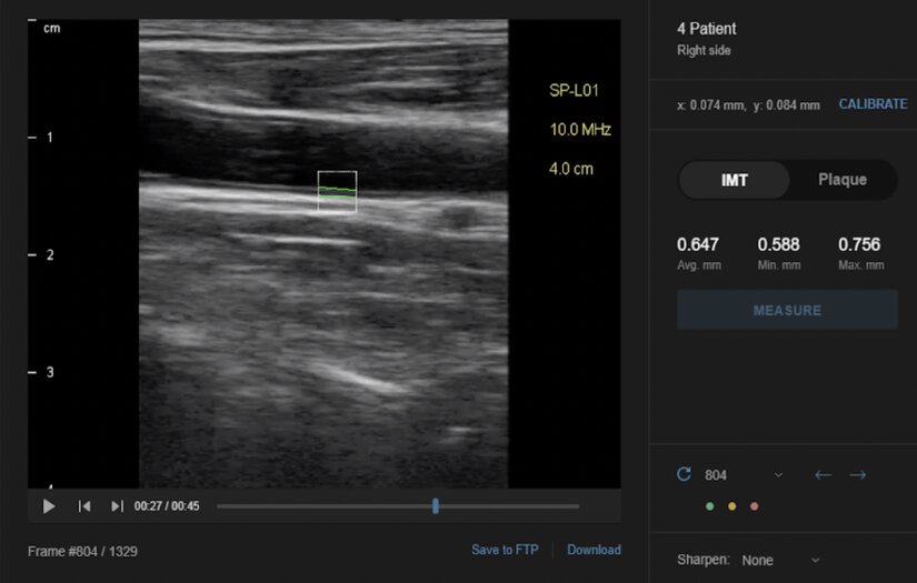 Machine Learning based automated workplace for artery scanning screenshot 1