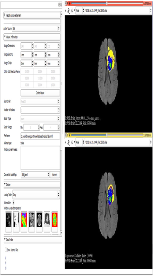 Brain Tumor Localization Application screenshot 1