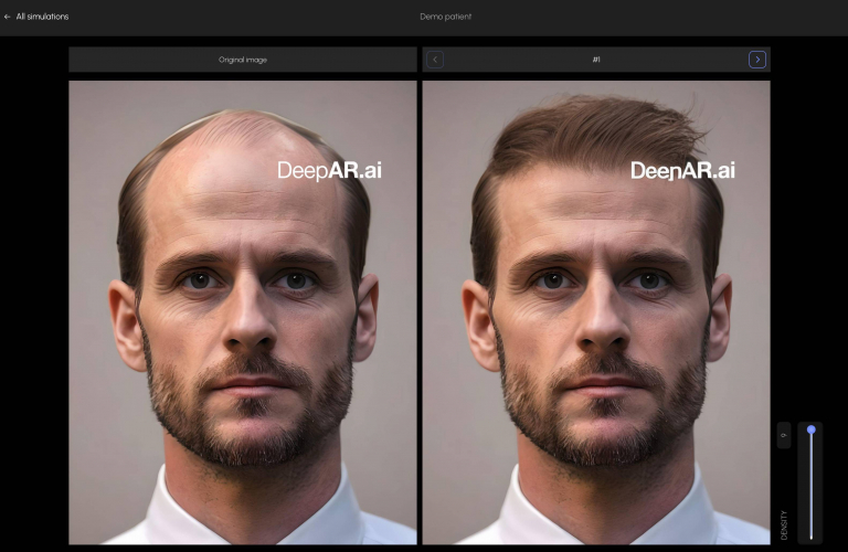 Hair Transplant Simulations screenshot 1