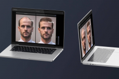 Hair Transplant Simulations