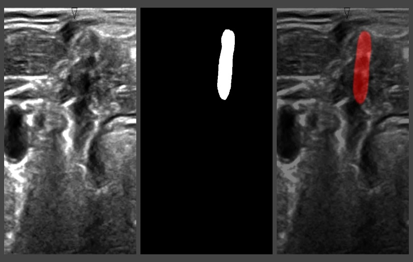 A solution to detect a brachial plexus on an ultrasound image screenshot 2