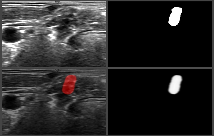 A solution to detect a brachial plexus on an ultrasound image screenshot 1